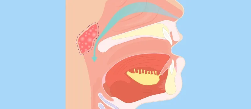 How to Approach a Patient with Adenoid Hypertrophy