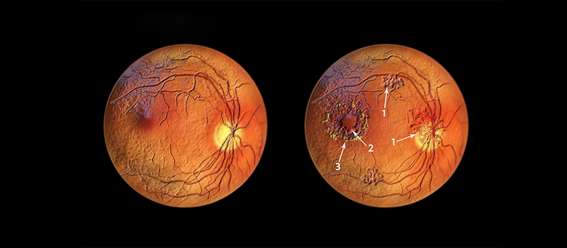 Cystoid Macular Edema (CME)