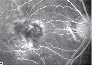 Fluorescein angiography shows cystoid macular edema